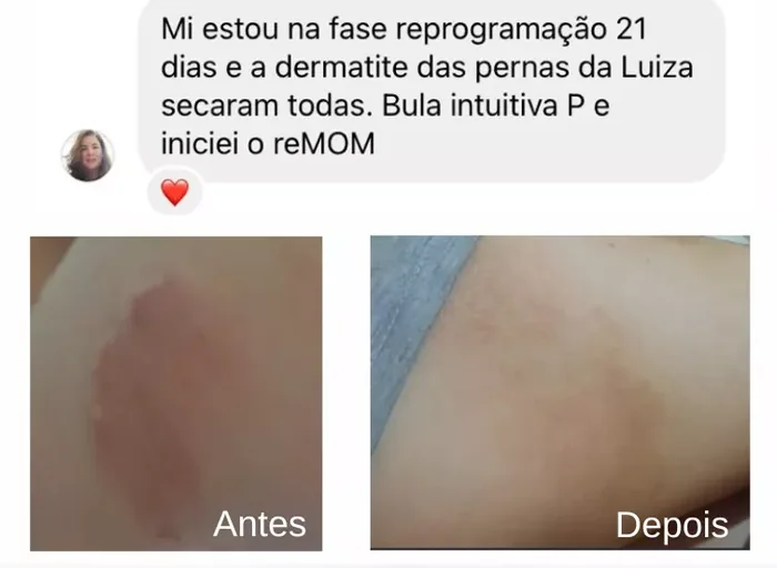 Print da Juliana com o antes e o depois da dermatite nas pernas da Luiza